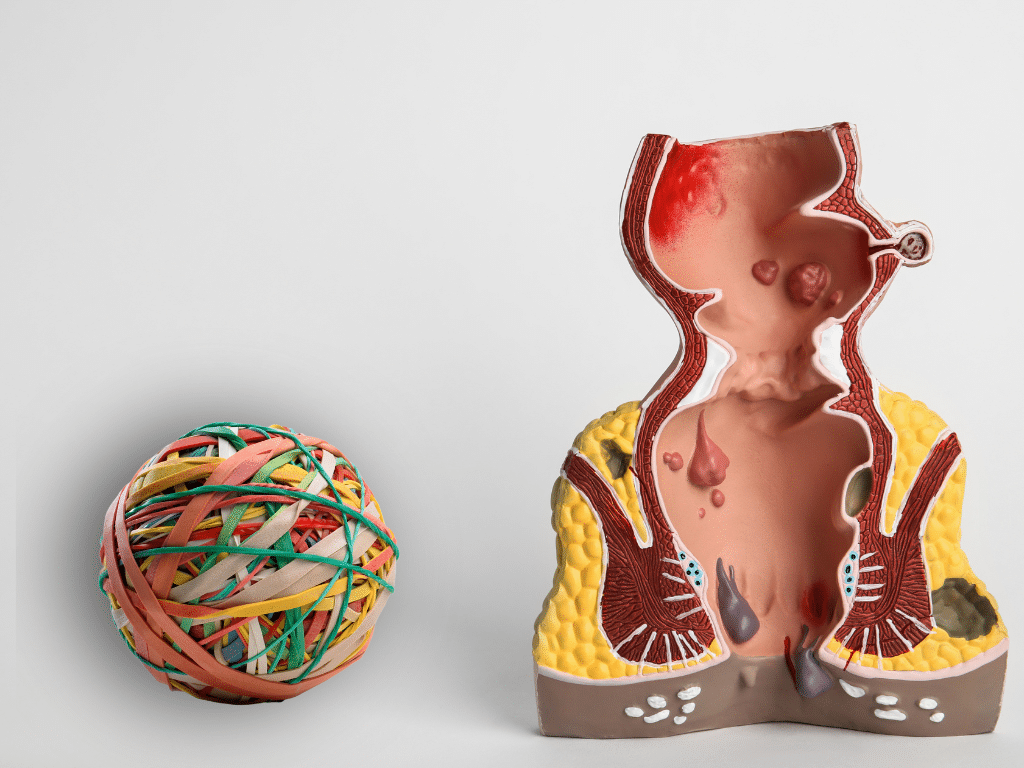 medical model of hemorrhoids next to a ball of elastic bands