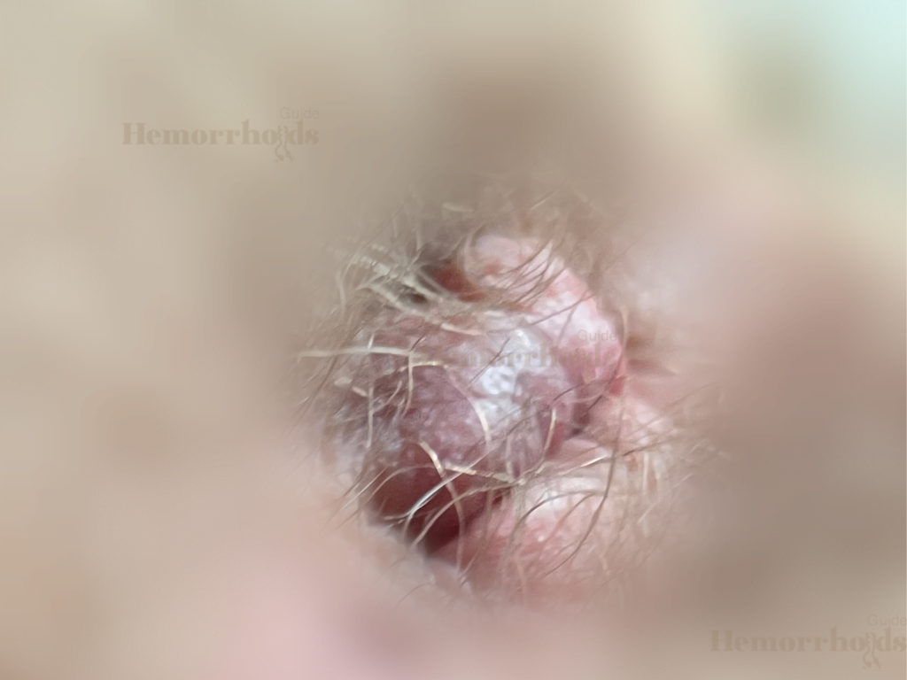 Real High Quality Close Up Picture of External Hemorrhoid Showing Out Of The Anus