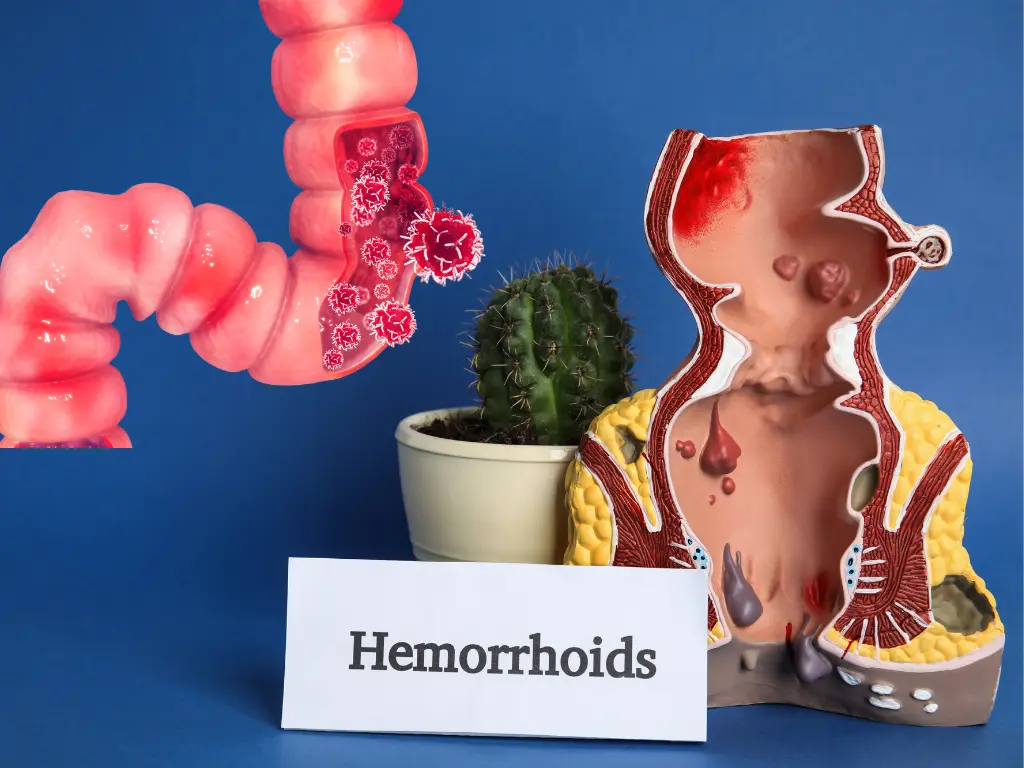 Illustration of a difference between hemorrhoids and polyps